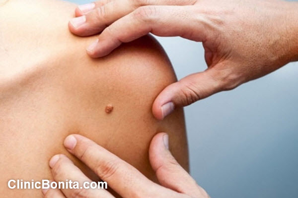 انواع سرطان پوست کدام است؟ | کلینیک بنیتای اصفهان