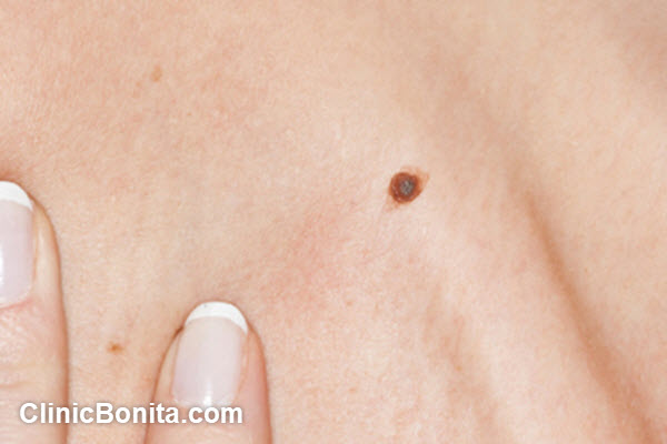 درمان بیماری بدخیم پوستی | کلینیک بنیتا اصفهان