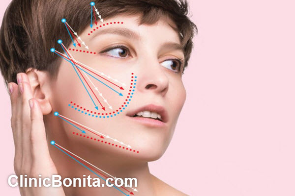 مدت زمان ماندگاری لیفت با نخ چقدر است؟ | کلینیک بنیتای اصفهان