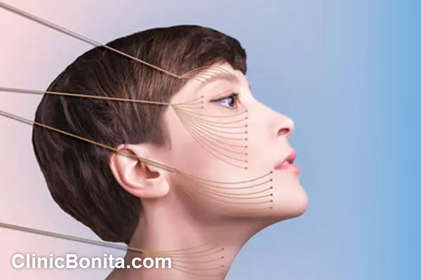 مزایای لیفت صورت با نخ | کلینیک بنیتای اصفهان