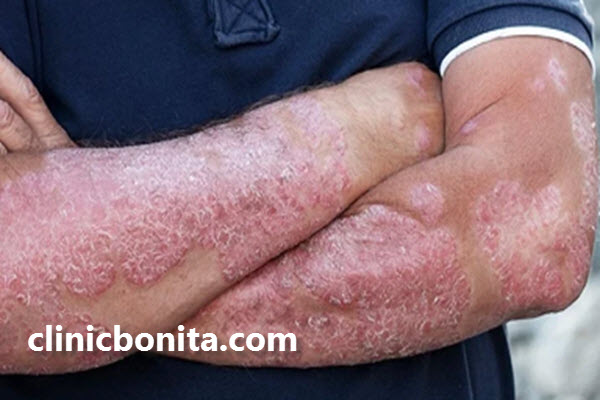 پسوریازیس چیست؟ | اصفهان