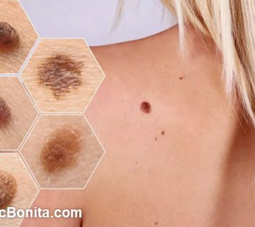 درمان بدخیمی پوست در اصفهان | کلینیک بنیتای اصفهان