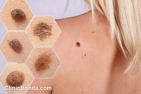 درمان بدخیمی پوست در اصفهان | کلینیک بنیتای اصفهان