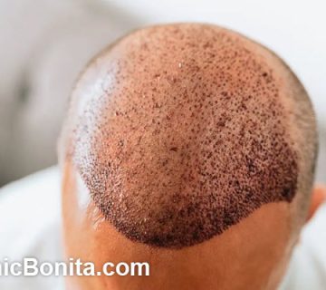 بزرگترین مرکز کاشت مو در اصفهان | کلینیک بنیتای اصفهان