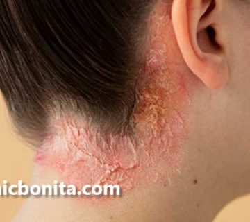 درمان سریع پسوریازیس در اصفهان