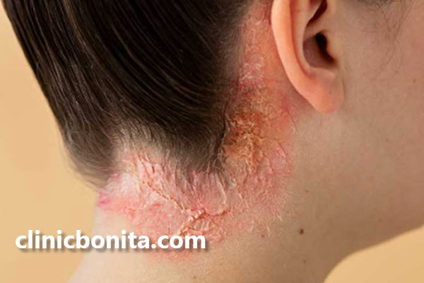 درمان سریع پسوریازیس در اصفهان