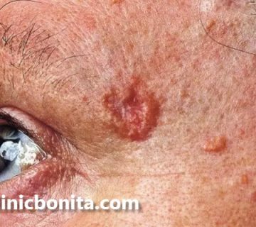 کلینیک تخصصی جراحی تومورهای پوستی در اصفهان