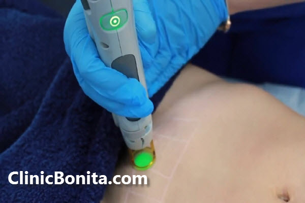 آیا لیزر بیکینی باعث نازایی می شود؟