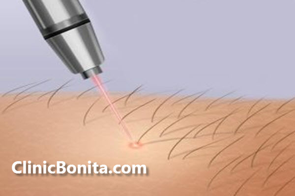 لیزر موهای زائد بیکینی چیست؟ | اصفهان