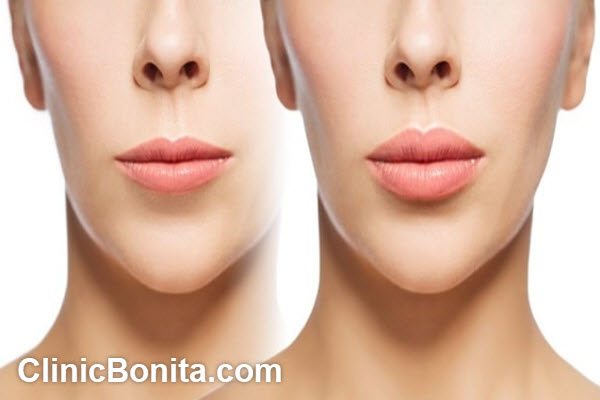 مراقبت های لازم بعد از لیفت لب برای افزایش ماندگاری آن | کلینیک بنیتای اصفهان