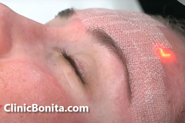 افراد جایز برای لیزر CO2 فرکشنال