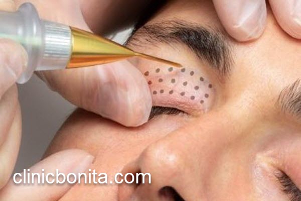 قیمت جراحی پلک با لیزر در سال 1404 | کلینیک بنیتای اصفهان