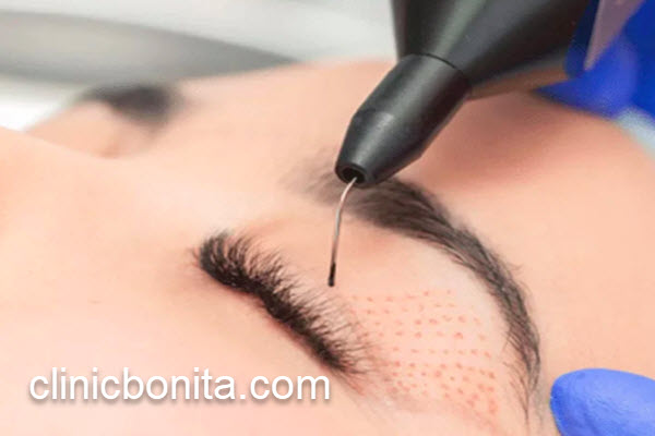 جراحی پلک با لیزر با هزینه مناسب | کلینیک بنیتای اصفهان