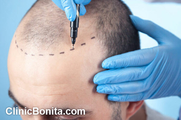 هزینه کاشت مو بر اساس تعداد تار مو چقدر است؟ | کلینیک بنیتای اصفهان