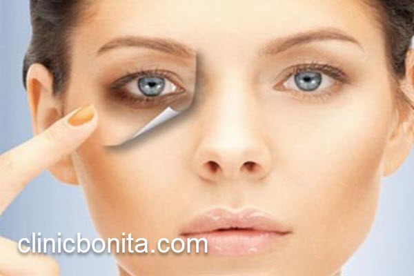 هزینه عمل بلفاروپلاستی پلک با لیزر | کلینیک بنیتای اصفهان