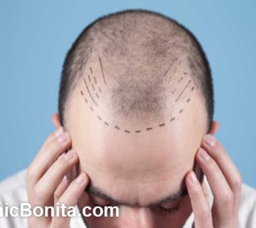 هزینه کاشت مو در سال 1404 چقدر است؟ | کلینیک بنیتای اصفهان