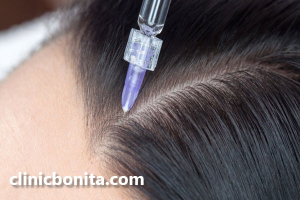 قیمت هر جلسه مزوتراپی مو | کلینیک بنیتا