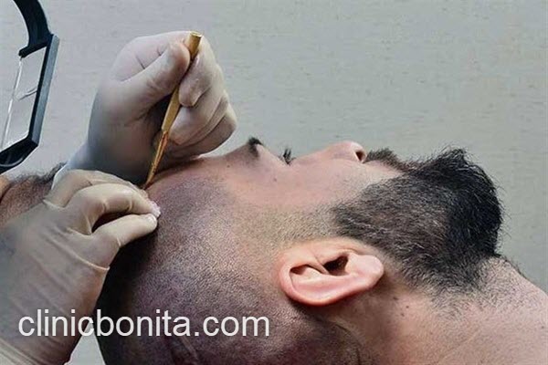 بهترین پزشک کاشت مو در ایران | کلینیک بنیتای اصفهان