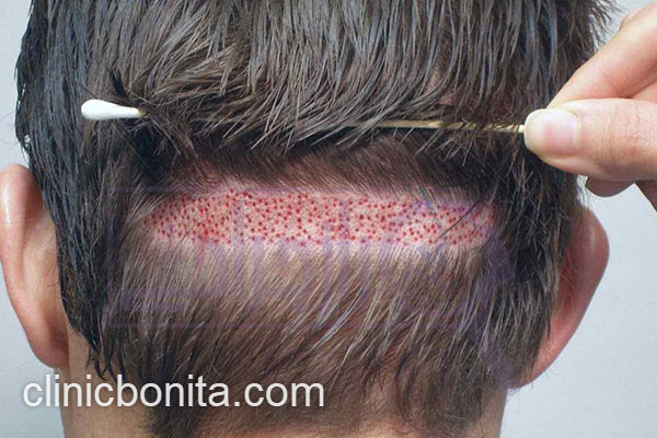 پزشک متخصص کاشت مو در ایران | کلینیک بنیتای اصفهان