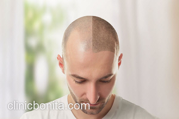 کلینیک تخصصی کاشت مو در اصفهان | کلینیک بنیتای اصفهان