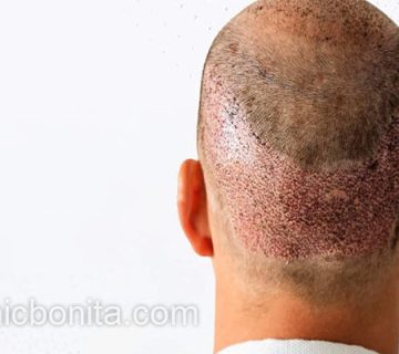 کاشت موی پر تراکم در کلینیک معتبر | کلینیک بنیتای اصفهان