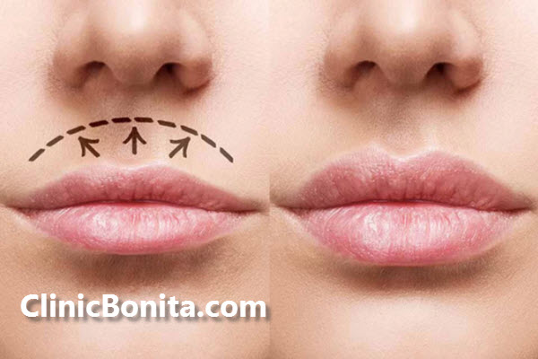 آیا سانترال لب دائمی است؟