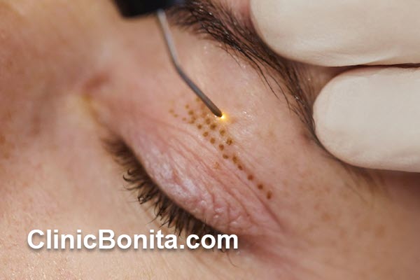 انواع روش های بلفاروپلاستی بدون جراحی کدامند؟