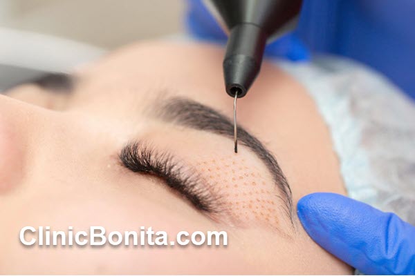 بلفاروپلاستی بدون جراحی چیست؟