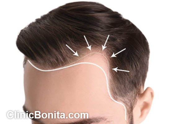 مراقبت های پس از درمان پی آر پی مو