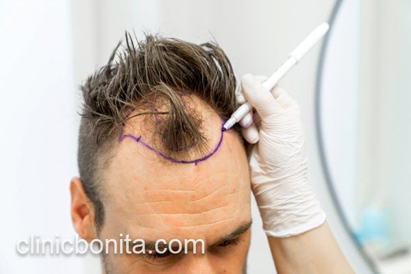 مرکز تخصصی کاشت مو در اصفهان | کلینیک بنیتای اصفهان