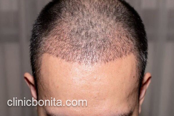 بهترین کلینیک کاشت مو | کلینیک بنیتای اصفهان