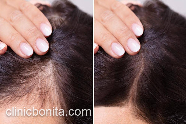 کاشت مو در پیشانی زنان با هزینه مناسب | کلینیک بنیتای اصفهان