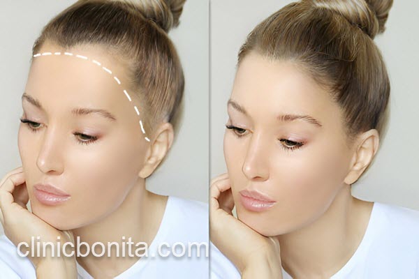 قیمت کاشت مو برای پیشانی زنان | کلینیک بنیتای اصفهان