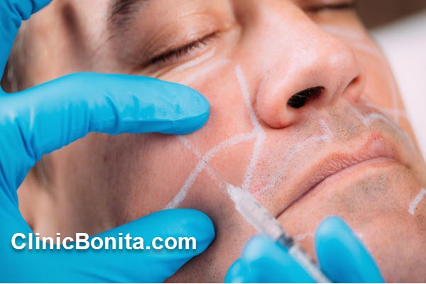 چند نوع فیلر گونه وجود دارد؟