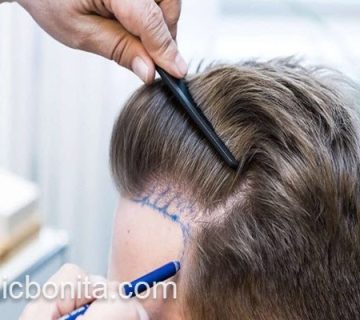 کاشت موی طبیعی در اصفهان | کلینیک بنیتای اصفهان