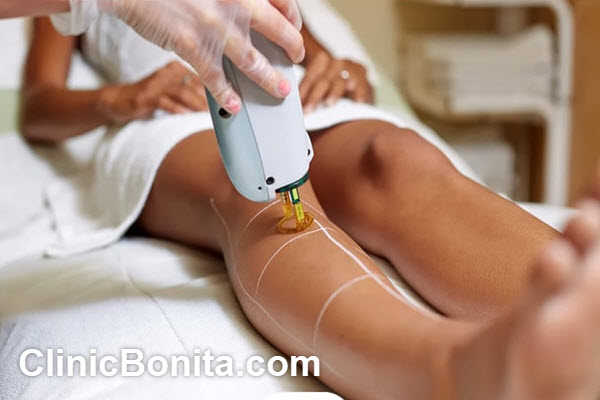 آیا لیزر موهای زائد دائمی است؟