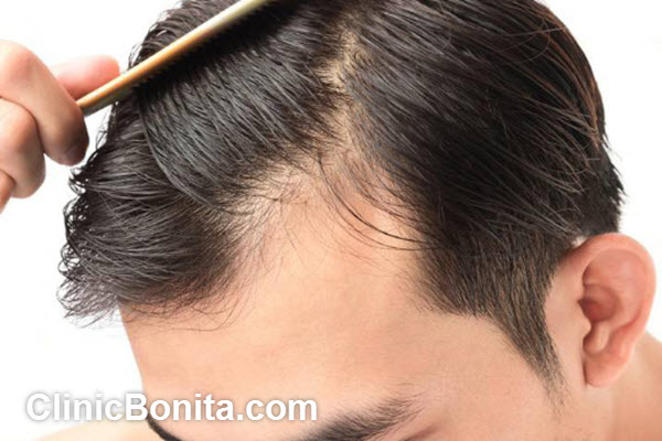 پی آر پی مو چند درصد جواب میده؟