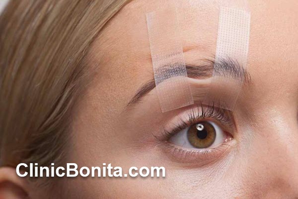 هزینه بلفاروپلاستی بدون جراحی چقدر است؟