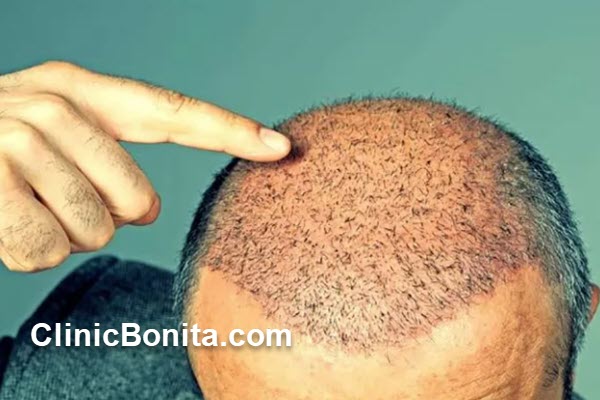 عوامل مؤثر بر هزینه کاشت مو