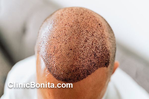 مزایای کاشت مو در کلینیک بنیتا اصفهان