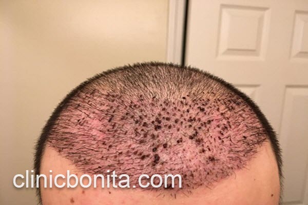 برترین کلینیک کاشت مو در اصفهان | کلینیک بنیتای اصفهان