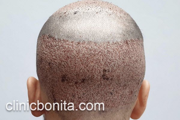 مرکز تخصصی کاشت مو در اصفهان | کلینیک بنیتای اصفهان