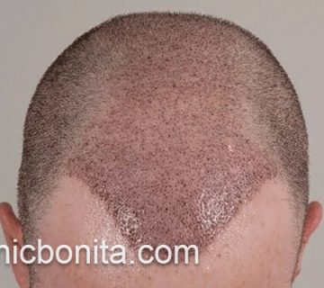 کاشت مو در کلینیک معتبر | کلینیک بنیتای اصفهان