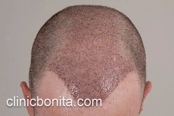 کاشت مو در کلینیک معتبر | کلینیک بنیتای اصفهان