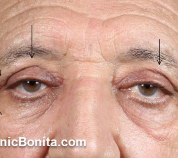 بهترین پزشک بلفارو در اصفهان