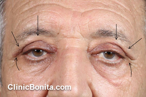 بهترین پزشک بلفارو در اصفهان