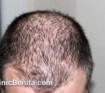 هزینه کاشت مو در سال 1404