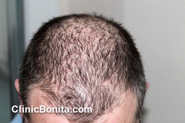 هزینه کاشت مو در سال 1404