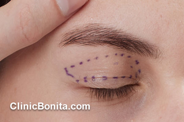 بلفاروپلاستی چیست و چه کاربردی دارد؟