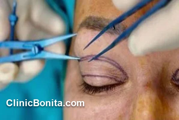 هزینه بلفاروپلاستی چقدر است؟